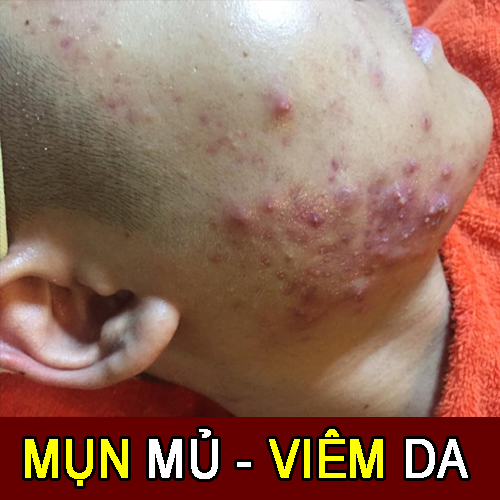 điều trị mụn viêm tại hà đông