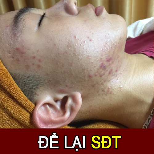 trị mụn tại arum spa hà đông