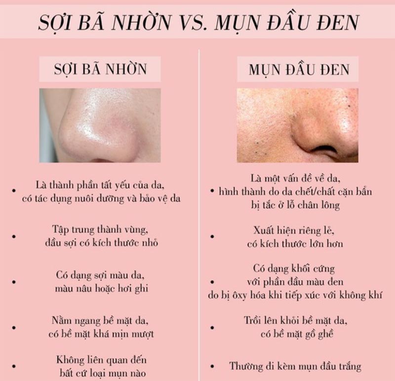 Phân Biệt mụn đầu đen với sợi bã nhờn