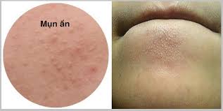 Điều trị mụn ẩn tại Hà Đông