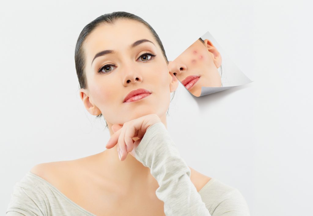 5 Bước chăm sóc da mụn đúng cách