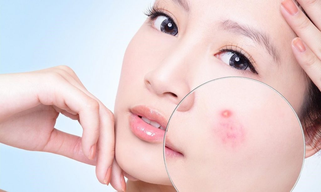 cách chăm sóc da mặt nhờn bị mụn