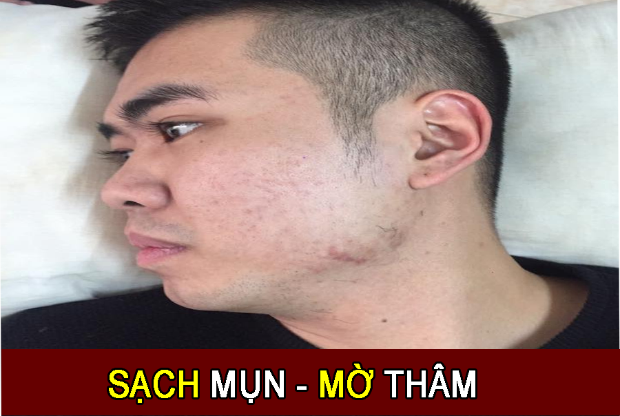 Trị mụn tại arum spa