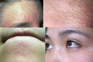 Quy trình điều trị mụn ẩn