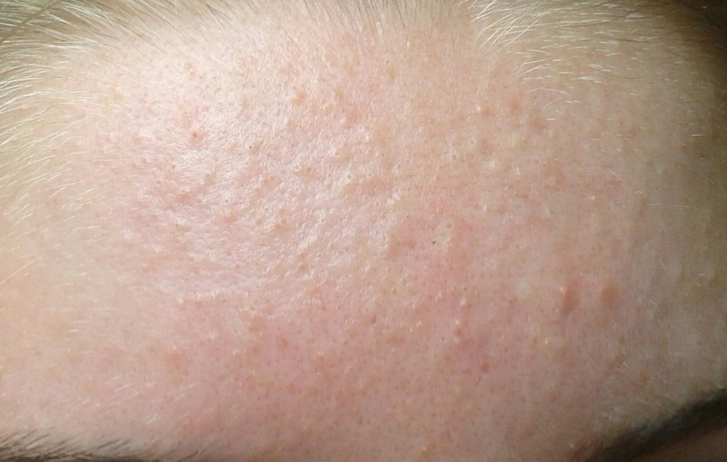 Trị mụn ẩn tại Hà Đông
